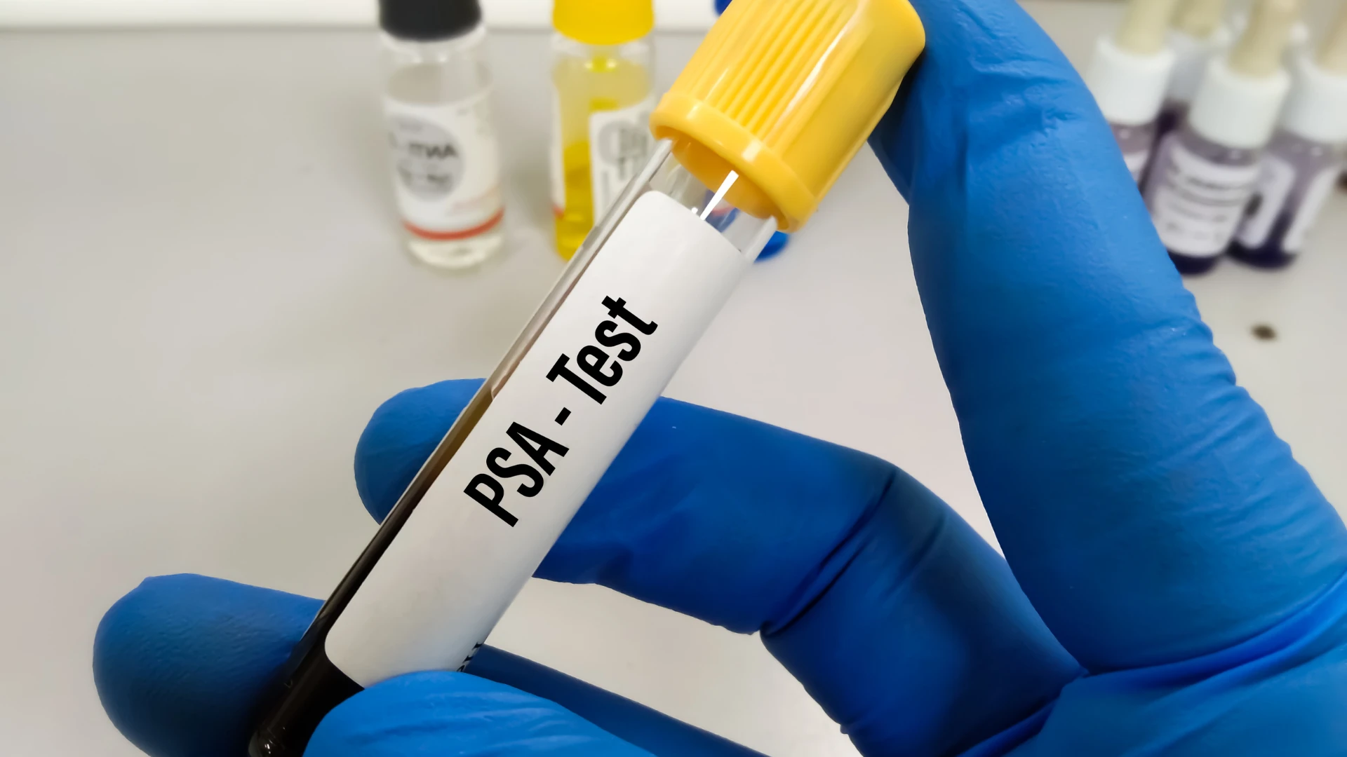 PSA and Free PSA Test